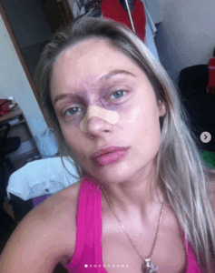 «Я люблю каждый свой шрам»: Наталья Рудова показала лицо в синяках