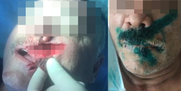 Волгоградцу разрезало лицо пополам из-за неисправной болгарки