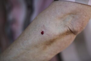 В Волгоградской области 80 человек пострадали от укусов клещей