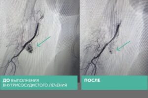 Волгоградские медики впервые без разреза удалили «сосудистый клубок»