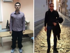 Волгоградские медики выпрямили ноги испанскому моднику