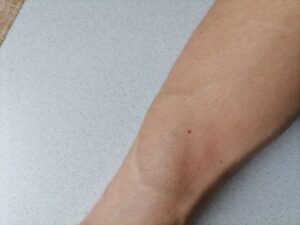 Новые факты о родинках рассказали онкологи