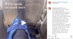 Полный брейс: Елена Малышева показала на видео изувеченную ногу