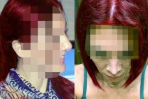 После двух неудачных операций волгоградка наконец обрела новое лицо